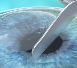 ¿Qué es la cirugía refractiva PRK?