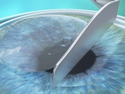 What is PRK refractive surgery?