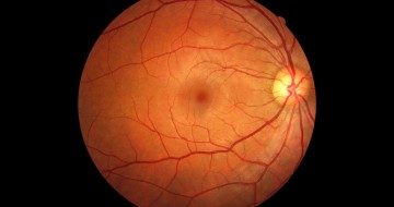  Desprendimiento de retina  