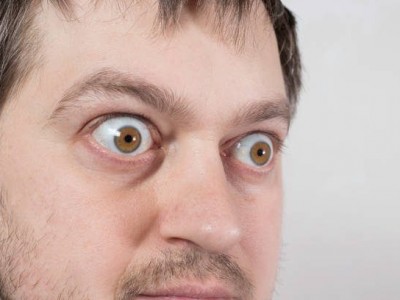What is exophthalmos? 