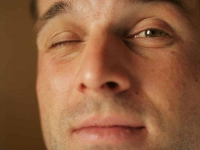 Inability to close eyelids