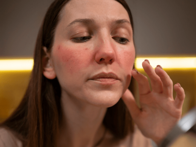 &iquest;C&oacute;mo afecta el lupus a la salud ocular?