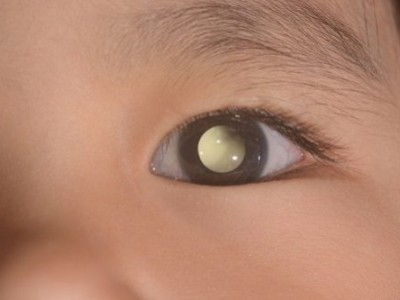 Eye Cancer