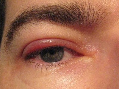 Inflammation of the eyelids, known as blepharitis