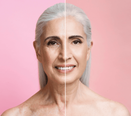 Let's talk about blepharoplasty