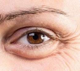 Bolsas debajo de los ojos