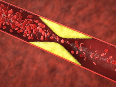 The relationship between high cholesterol and vision