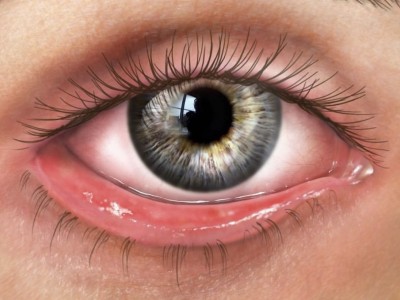 What is ectropion?