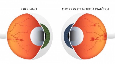 La Diabetes y sus efectos en la visi&oacute;n. Diario Salud