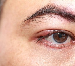 What is a chalazion and how is it different from a stye?