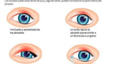 El orzuelo &iquest;C&oacute;mo prevenir su aparici&oacute;n?. Diario Libre 