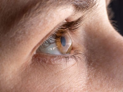What is corneal crosslinking?