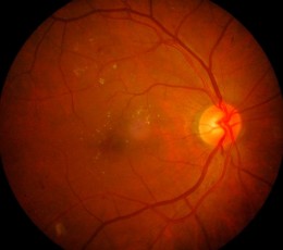 Hypertensive retinopathy
