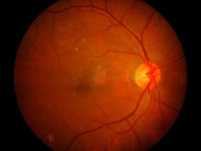 Retinopat&iacute;a hipertensiva