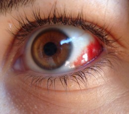 Hemorragia subconjuntival