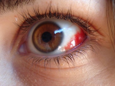 Hemorragia subconjuntival